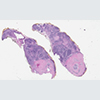 Papillary carcinoma, thyroid (40X, H&E)