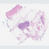 Invasive ductal carcinoma with DCIS, breast (40X, H&E)